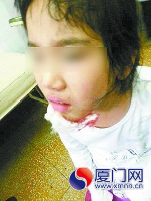 超市内打滑摔跤女孩下巴缝四针(图)