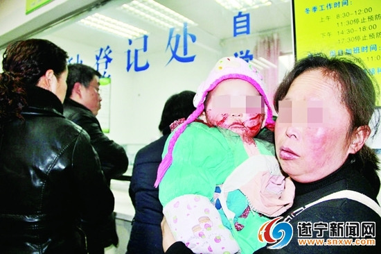 1岁女童被自家狗咬伤脸缝20针今后或留疤(图)