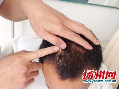 抑郁症小伙向自己头部射入6根钢钉深达脑浆(图)