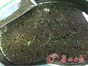 男子腰痛2年医生从其右肾取出千颗结石(图)