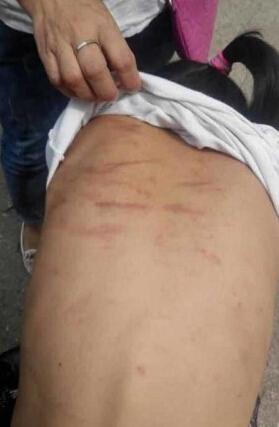 9岁女童常遭亲妈拳打脚踢竹棍抽称“仍爱妈妈”