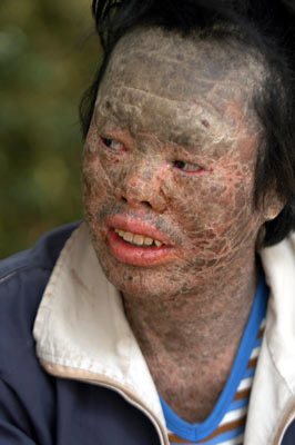 怪病男子全身长"鱼鳞"奇迹存活 以钓鱼为生(图)