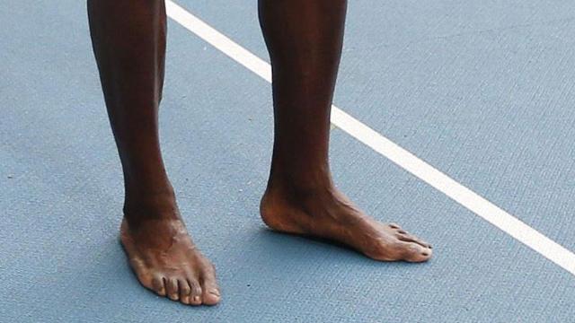 我和我的小伙伴们都惊呆了博尔特脚部变形严重