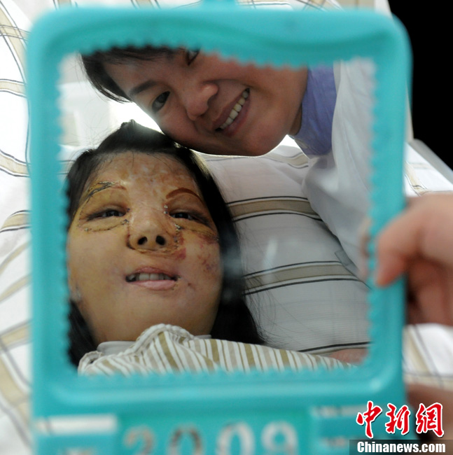 福建首例中国式换脸手术成功换脸少女对镜微笑