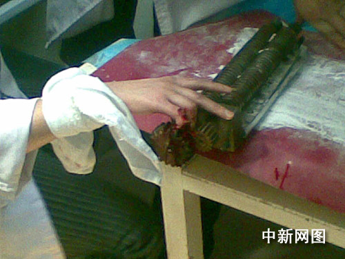 图哈尔滨一女子手指被夹压面机内2