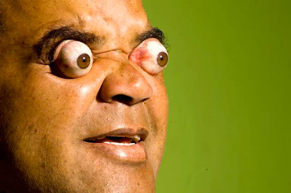 巴西一男子眼球能弹出4厘米 只剩5%留眼眶人们常用"眼珠都差点弹了