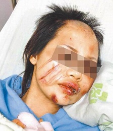 台湾男子疑女友出轨致其脸花、胸臀伤痕累累