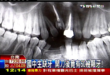 台湾初中生缺牙手术后发现有60多颗牙
