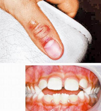 爱吸拇指台湾8岁男童一口乱牙上腭发育异常