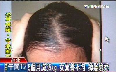 减肥过度可能变秃头台医师:因营养摄取不均衡