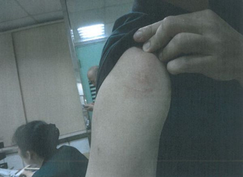 台男子骑车突感剧痛脸被风筝线割裂13公分(图)