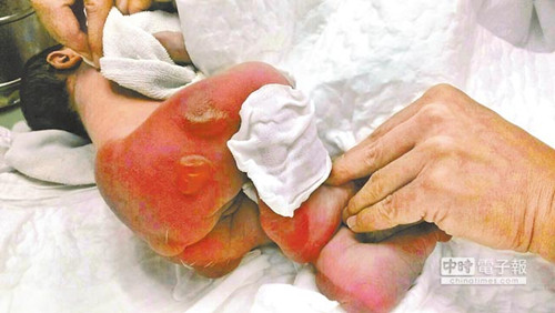 出生3小时女婴遭医院电热毯烫伤双亲怒控妇产科