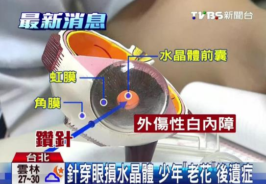 洗牙针直插眼球医生大意险致男子眼瞎