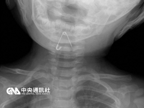 ̨10���´���Ӥ��ʳ����̽�����������ҽ�޴�