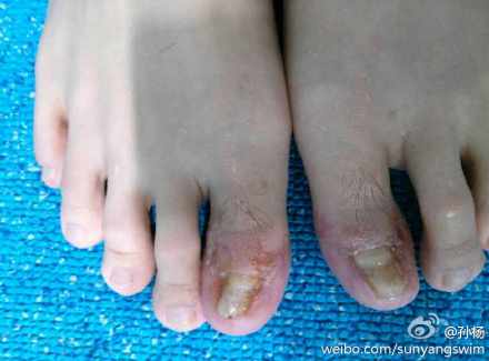 孙杨微博晒脚趾受伤部分网友不买账称矫情(图)