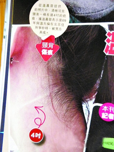 温兆伦前女友曝曾被其拿刀砍脖子晒伤口照(图)