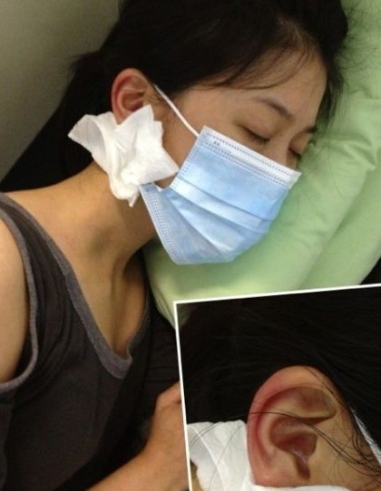 卓文萱耳朵里面爬进蜘蛛惨被咬伤痛苦就医图