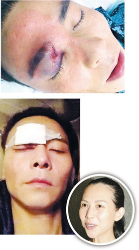 张晋拍打戏伤右眼角缝五针太太蔡少芬心痛(图)