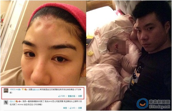 黄奕称被家暴头部凹陷老公:打玻尿酸手按的