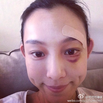 范玮琪晒康复近照左眼依旧淤青(图)