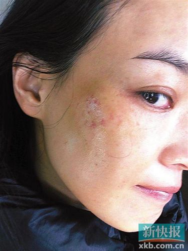 舒淇脸颊摔成乌青晒脸部特写曝伤痕图