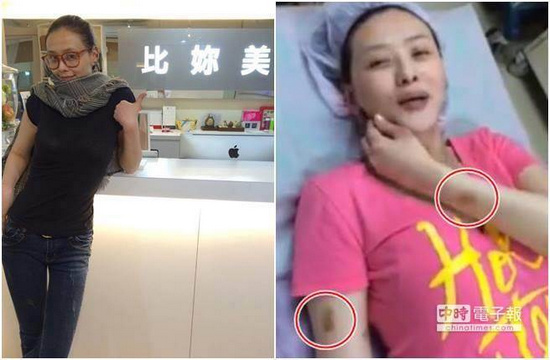 台湾女星萧淑慎晒整形视频手臂现淤青(图)