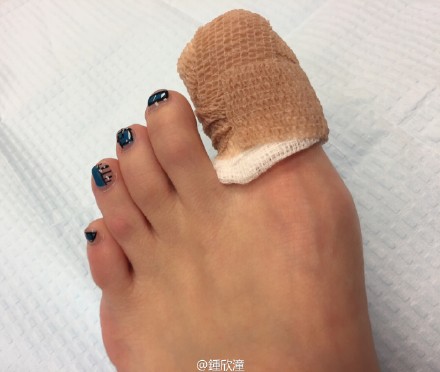 阿娇未打麻药脚趾放淤血大呼“痛到快晕了”(图)