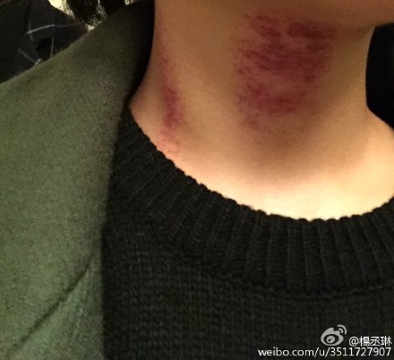 杨丞琳晒颈部刮痧照网友:我感受过,真的痛(图)